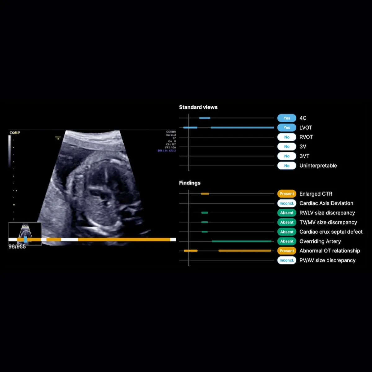Prenatal Ultrasound, Reinvented: How BrightHeart AI Catches 90% of Deadly Fetal Heart Defects Before Birth